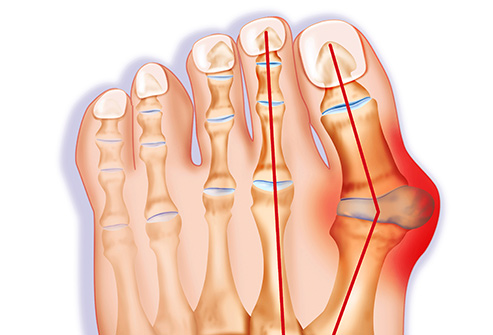 Bunion & Overlapping Toes