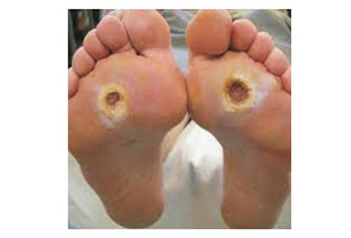 Diabetic Foot Ulcer