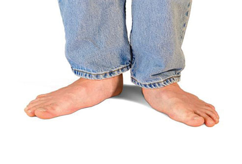 Flat feet in children