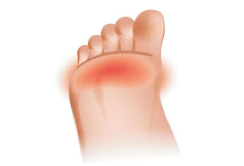 Fore foot Pain