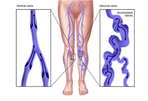 What are Varicose veins